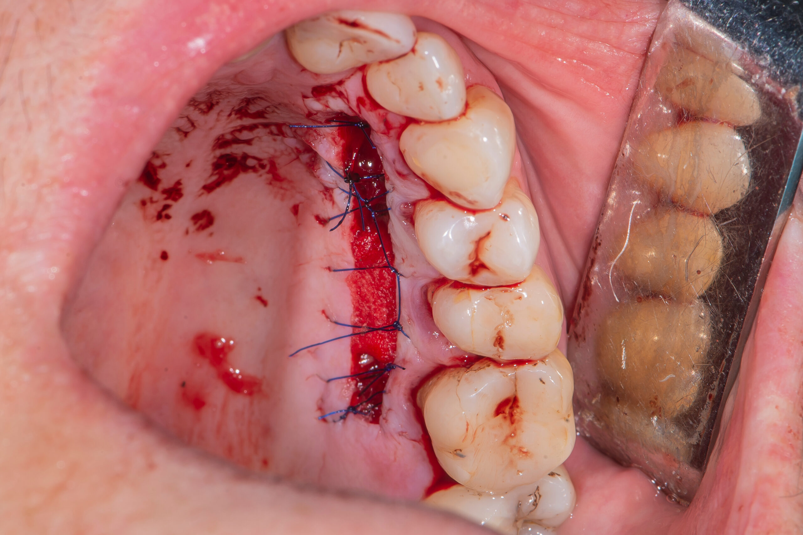 Dental implants in real patient surgery