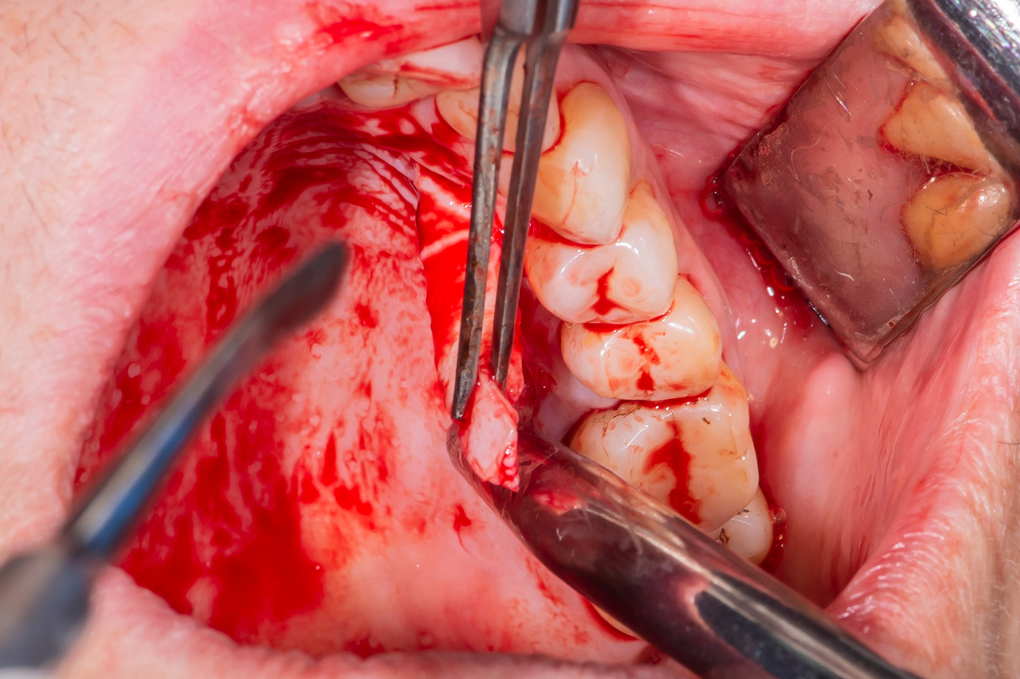 Dental implants in real patient surgery
