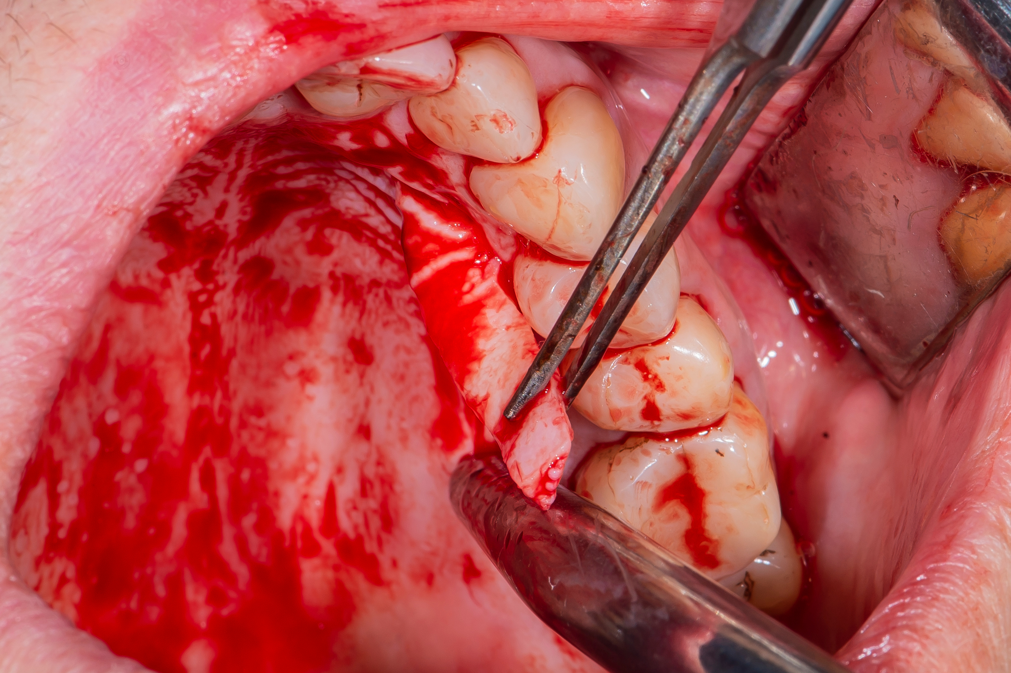 Dental implants in real patient surgery