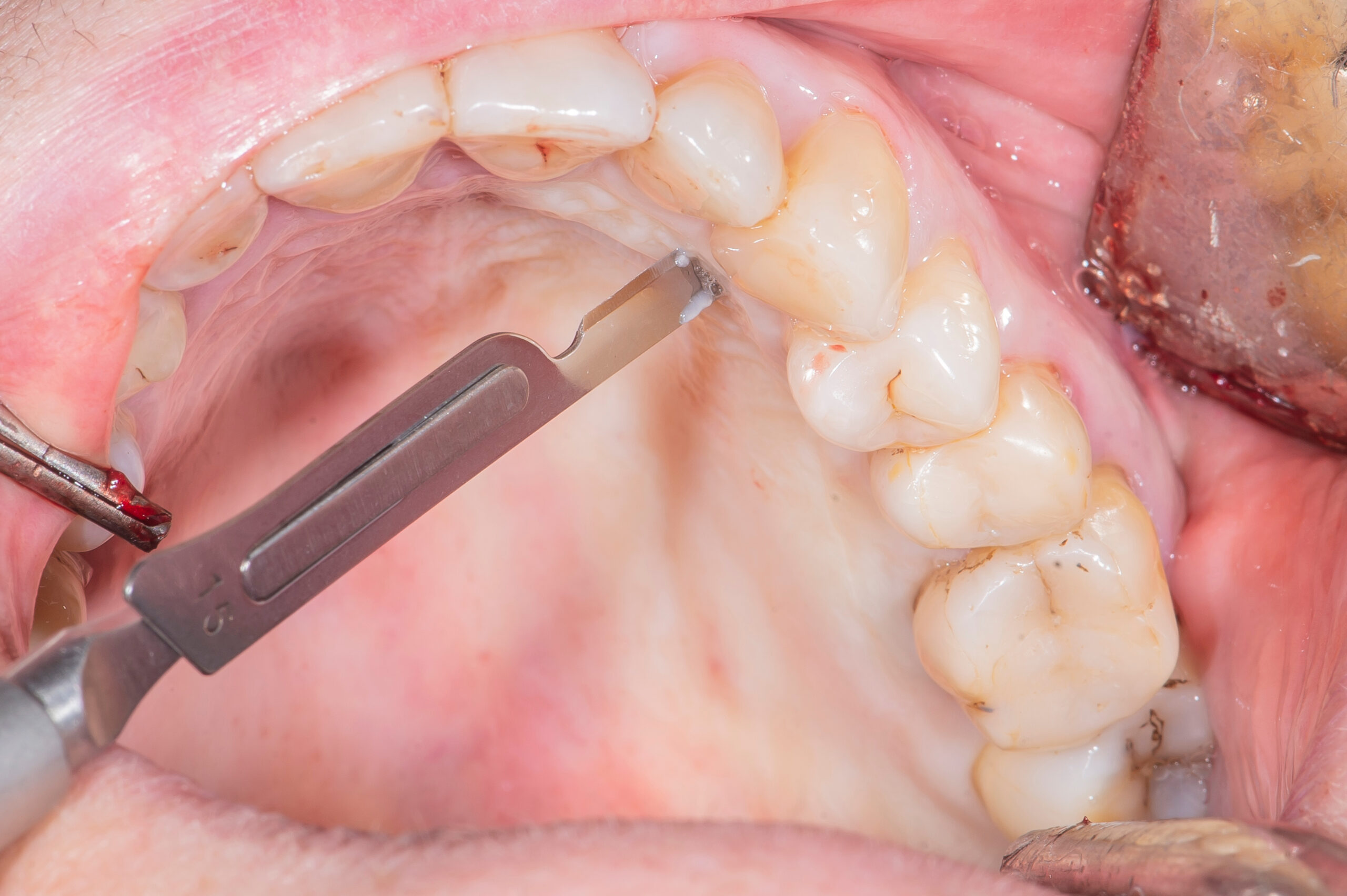Dental implants in real patient surgery