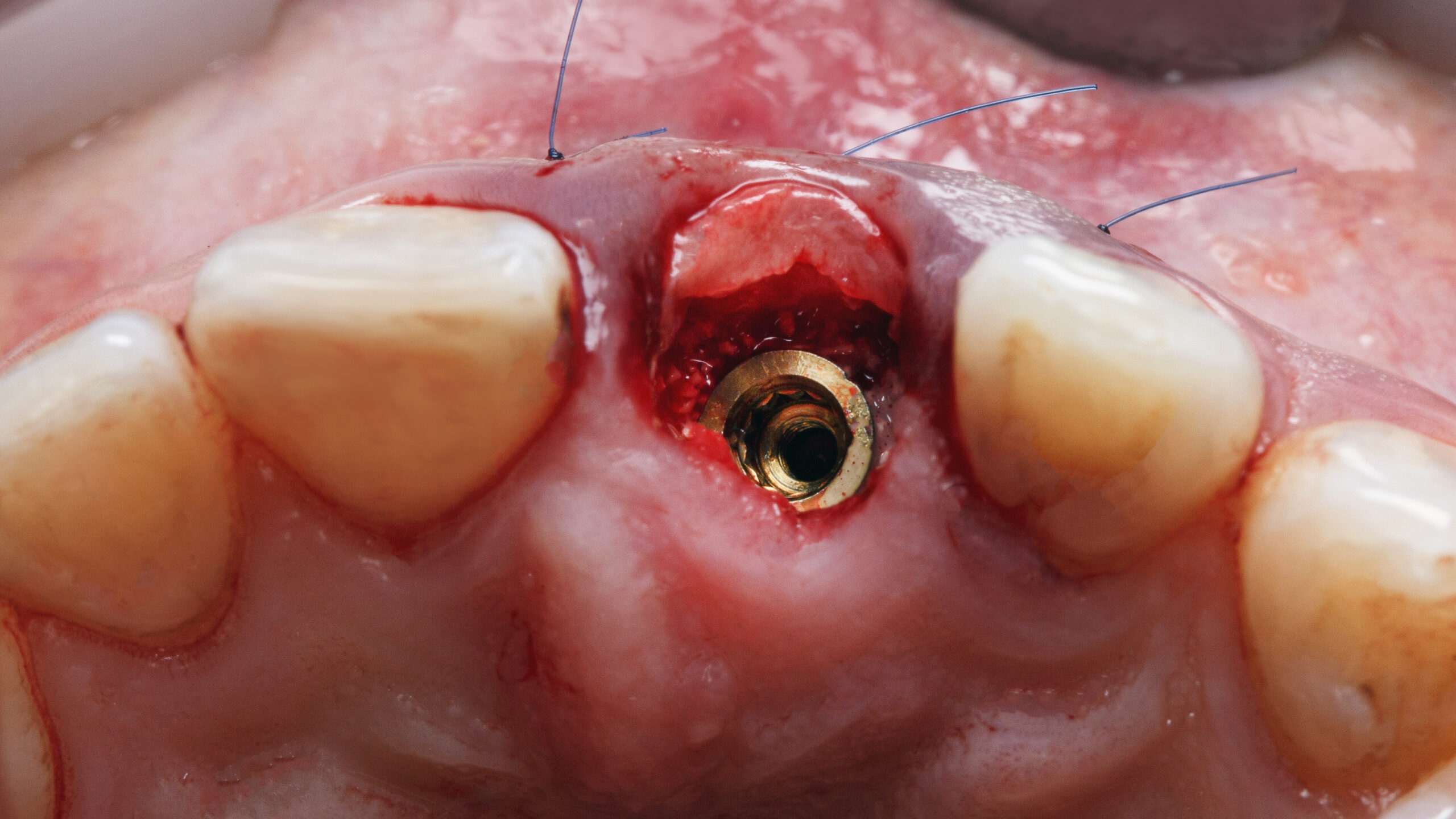 view of the installed abutment dental and soft tissue graft in the area of the central tooth