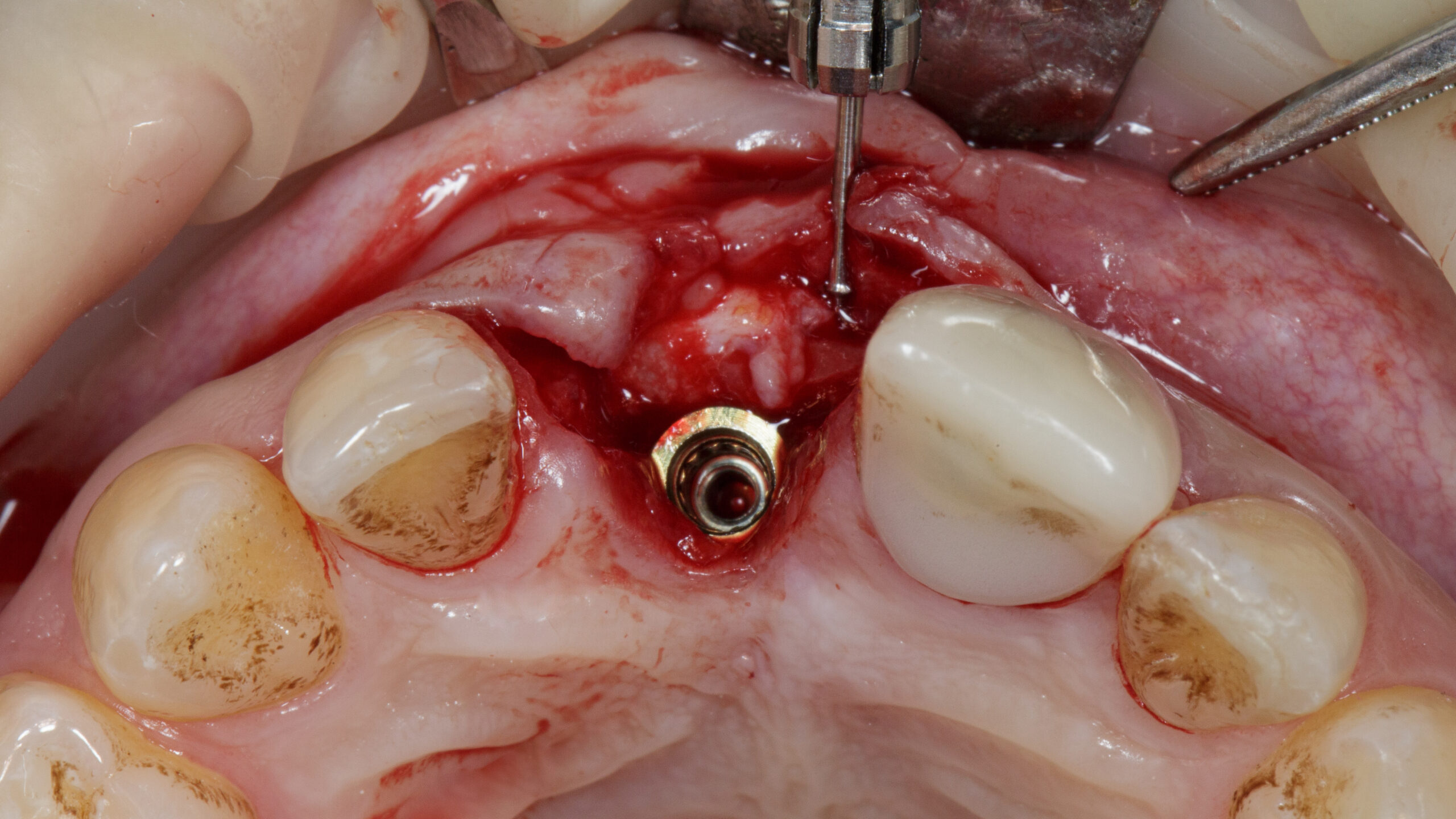 Installed central tooth implant with bone transplantation