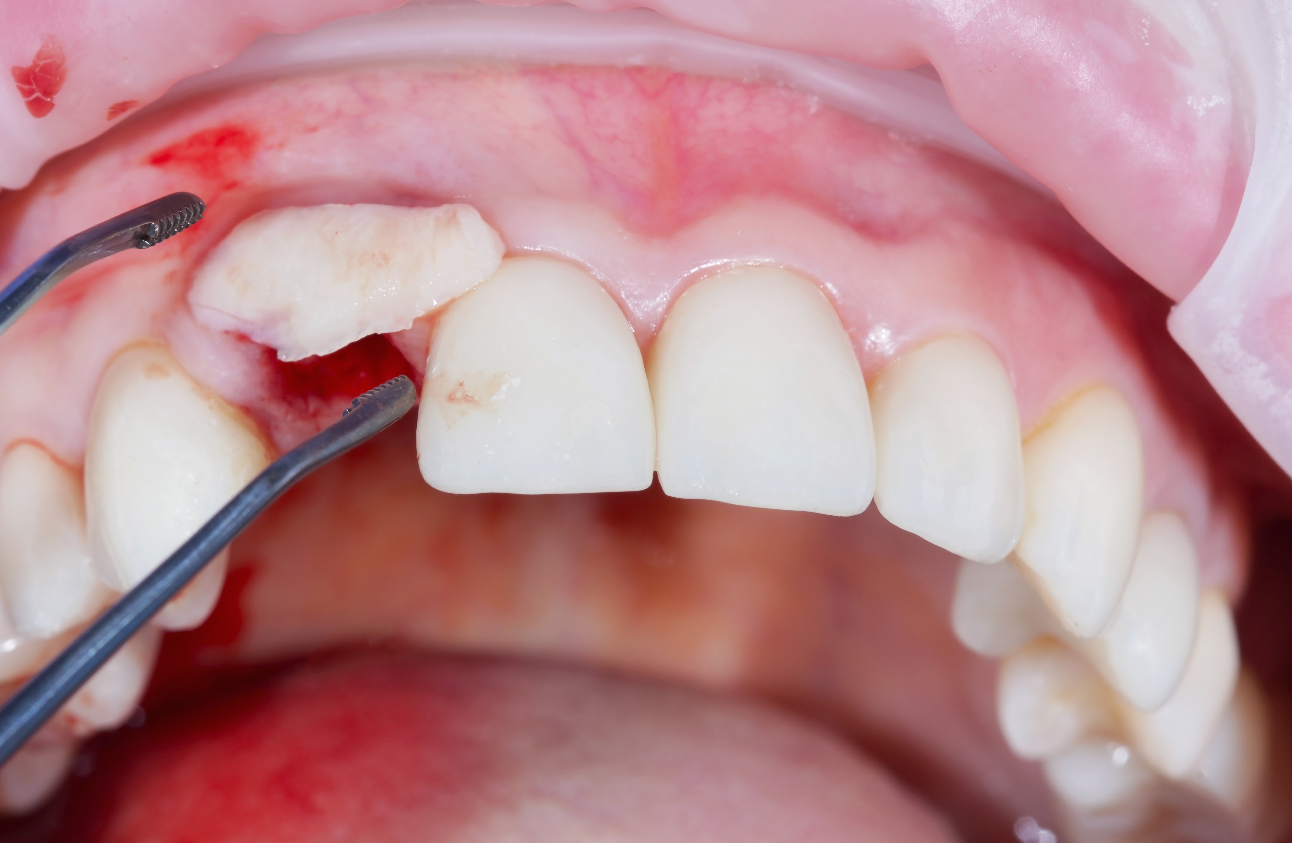 Soft tissue augmentation procedures. Gum grafting from the palate into the area of the removed tooth together with the installation of the implant. To compensate for soft tissue failure.